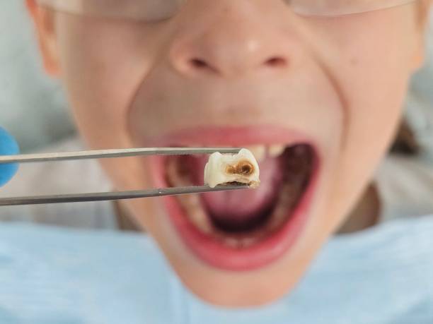 Best Emergency Tooth Extraction in Stearns, KY